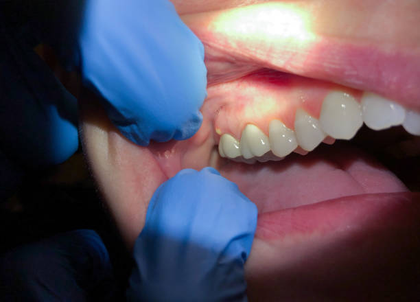 Best Emergency Tooth Extraction in Northville, MI